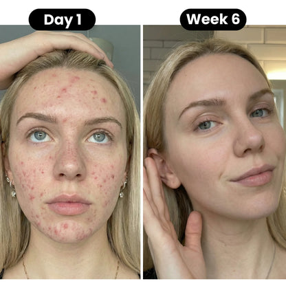 acne-before-and-after